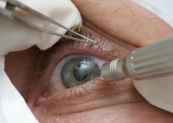 Médicos alertam para riscos de cirurgia de mudança da cor dos olhos