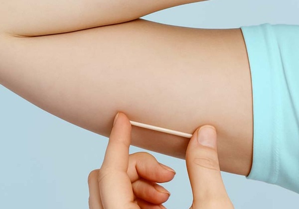 Salvador passa a oferecer Implanon de forma gratuita na rede municipal de saúde